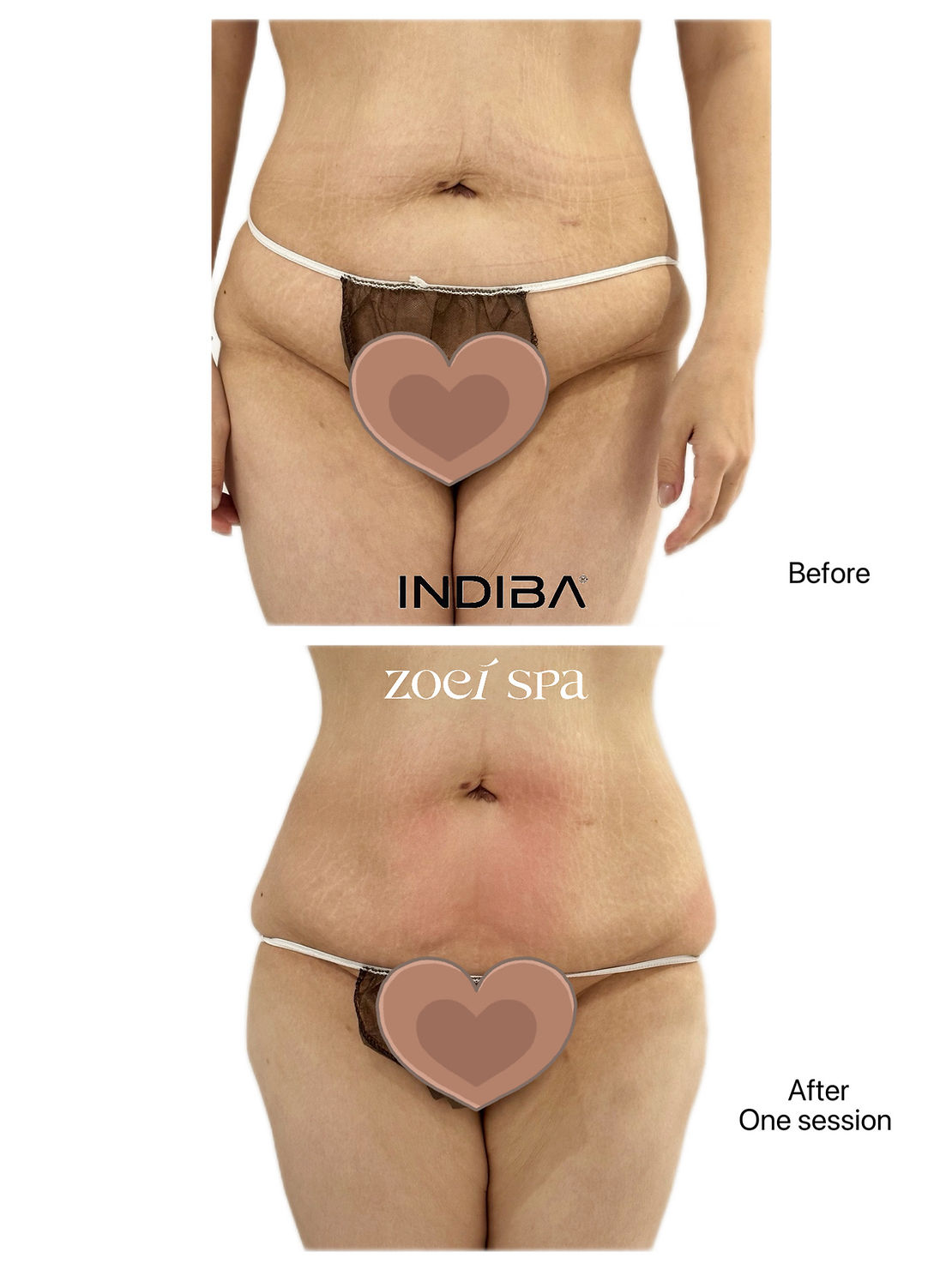 INDIBA 英特波 護理紀錄