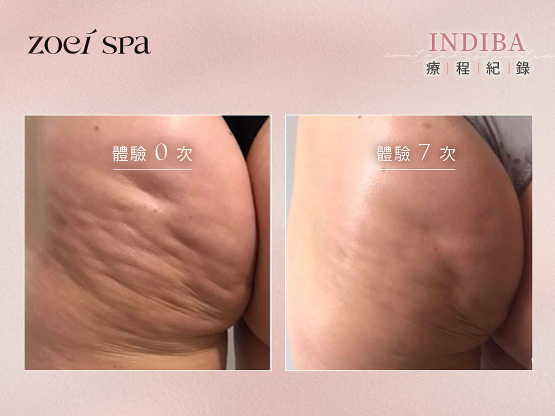 INDIBA 英特波 護理紀錄