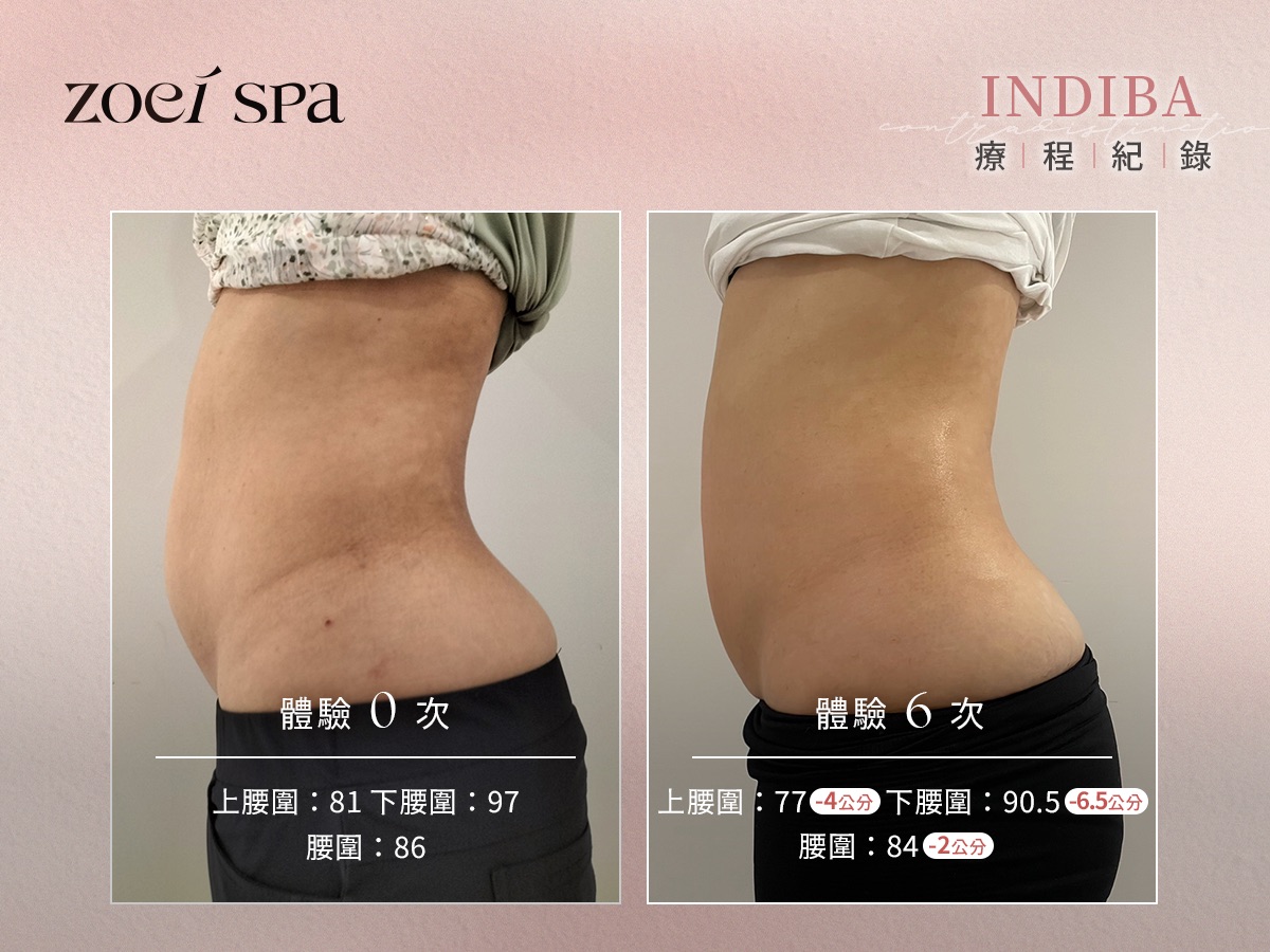 INDIBA 英特波 美容護理案例照片 2