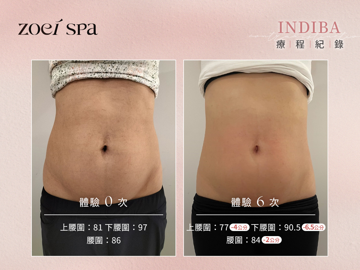 INDIBA 英特波 美容護理案例照片 3