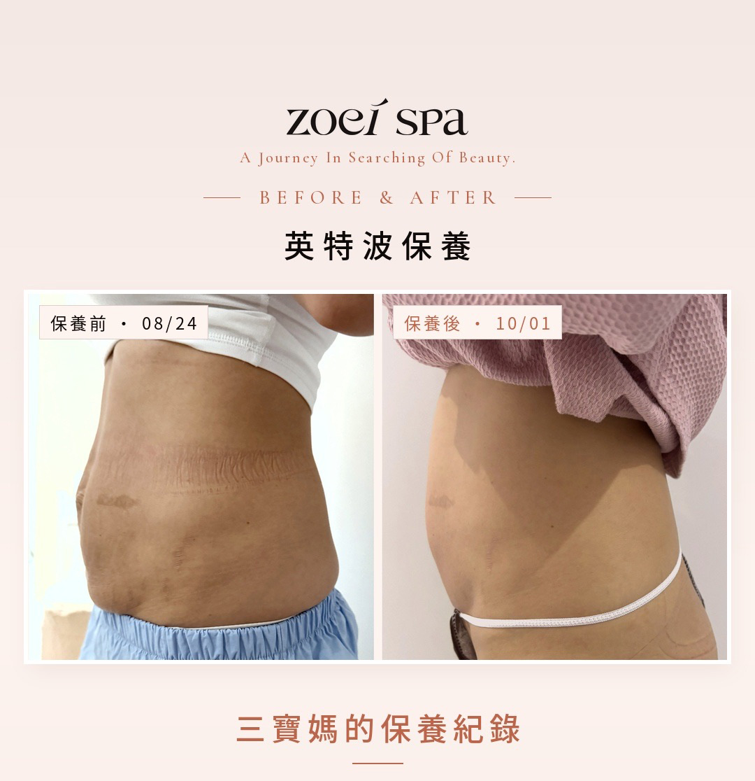 INDIBA 英特波 美容護理案例照片 6
