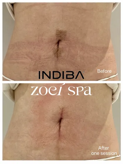 INDIBA 英特波 — 臀腿保養紀錄