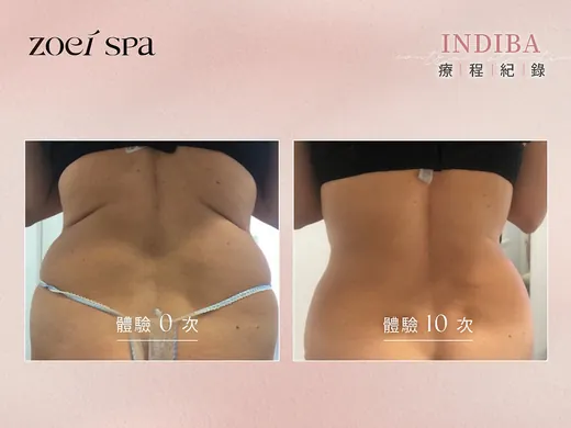 INDIBA 英特波 — 後背線條重新立體